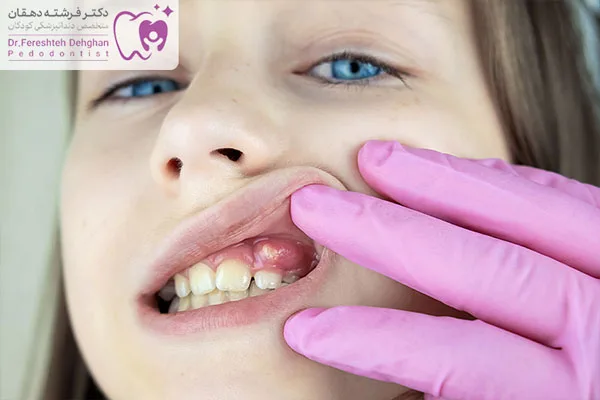 فرق آبسه و عفونت دندان کودک