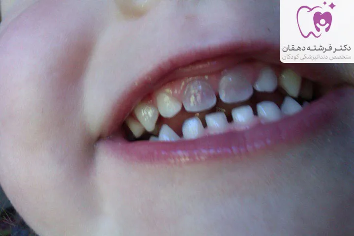 سیاه شدن دندان کودک دو ساله