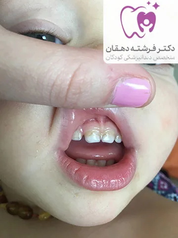 سیاه شدن دندان کودک یکساله