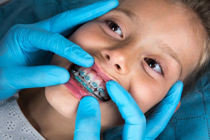 بهترین سن ارتودنسی دندان کودکان