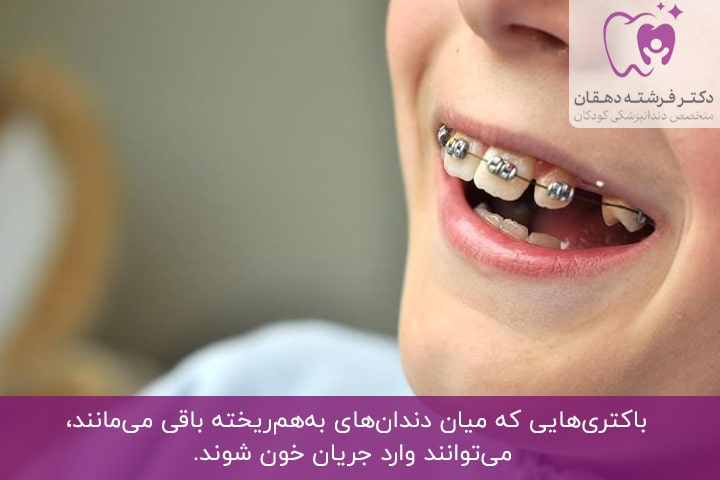 عوارض نامنظم بودن دندان کودکان
