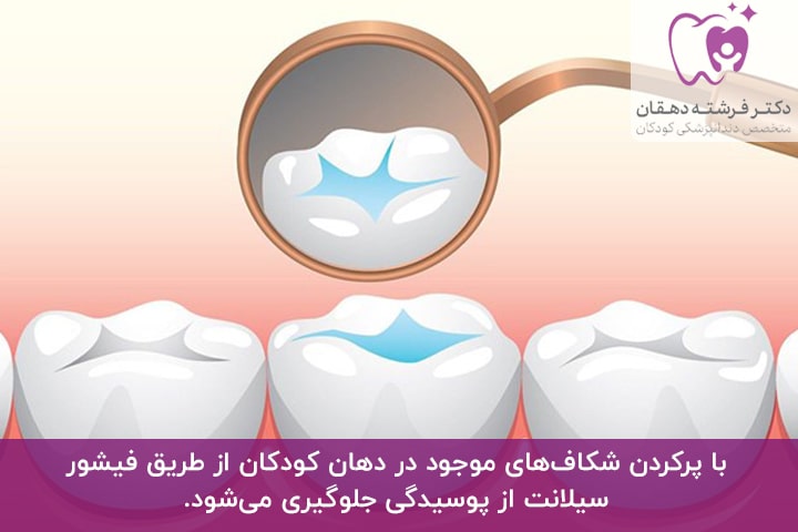 پرکردن شکاف دندان با روش فیشور سیلانت