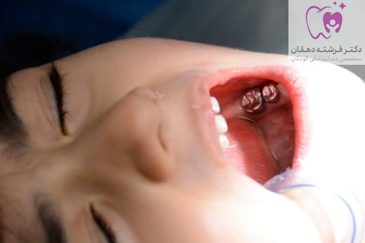 درد روکش دندان کودک