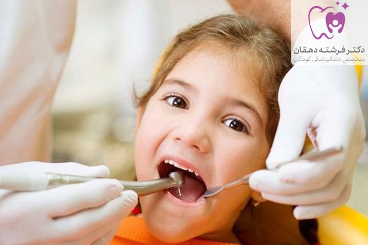 مراحل روکش‌ دندان‌ شیری‌
