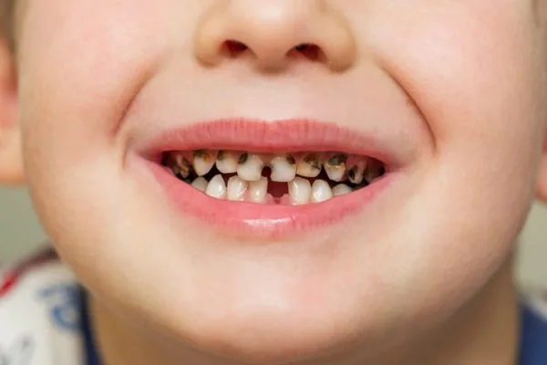 علت سیاه شدن دندان کودک