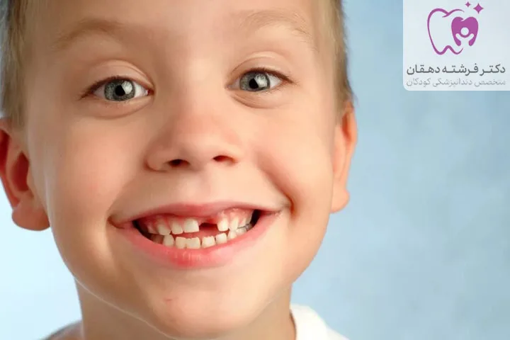 علت سیاه شدن دندان کودک | کلینیک دکتر دهقان